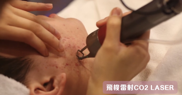  CO2 Laser飛梭雷射療程 ➡ ＄188 / 1️次 (局部) ➡ ＄388 / 1次 (全面)