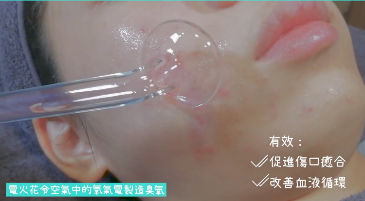 深眉殺菌暗瘡纖滅治療  ➡ ＄128 / 1️次 ➡ ＄298 / 3次  