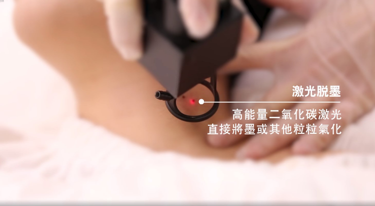 CO2 碳化激光脫墨/ 脫油脂粒  ➡ ＄188 / 6粒 ➡ ＄288 / 10粒  